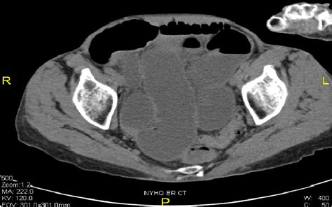 Femoral Hernia Sac Laparoscopy A Case Report Sages Abstract Archives