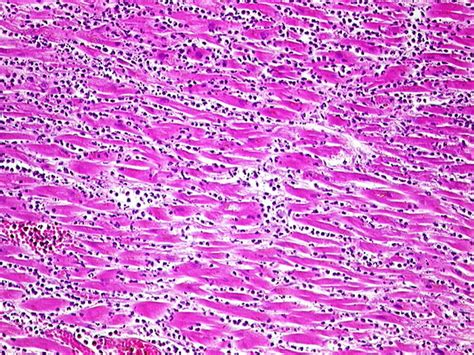 With acute myocardial infarction, very fast and adequate emergency care should be provided, after which the drug treatment is performed as soon as possible. Webpathology.com: A Collection of Surgical Pathology Images