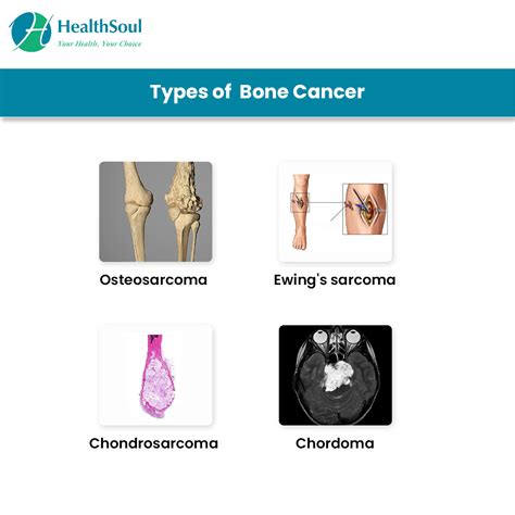 Bone Cancer Symptoms And Treatment Healthsoul