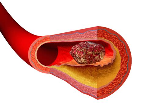 Covid 19 Can Trigger Lethal Blood Clots In Arms Can Lead To Recurrence