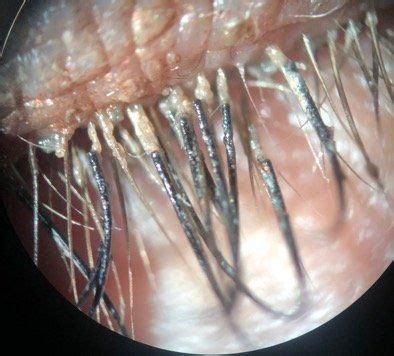 Eyelash Mites Causes Symptoms Prevention Treatment