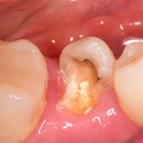 Saving Severely Decayed Lower Second Premolar Myzerodonto
