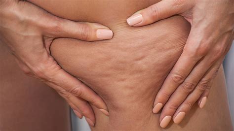 Why Some Women Get Cellulite And Others Dont Venus Treatments