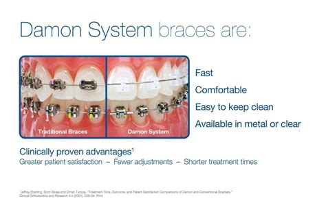Damon System Braces Are Fast Comfortable East To Clean And Available