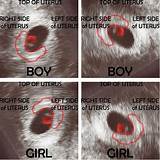 When Is The Earliest You Can Tell Gender On Ultrasound Images