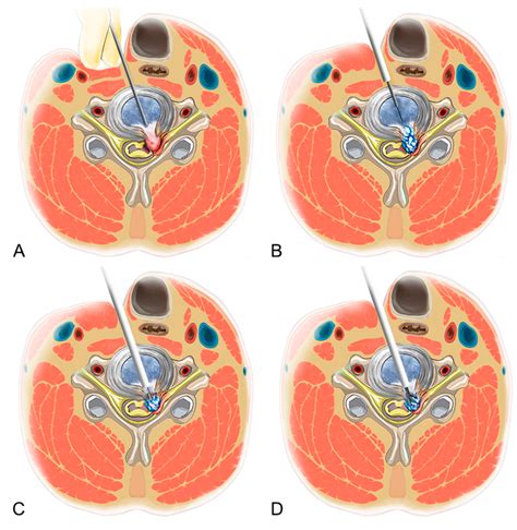 Basic Principle Of Percutaneous Endoscopic Cervical Discectomy PECD Download Scientific