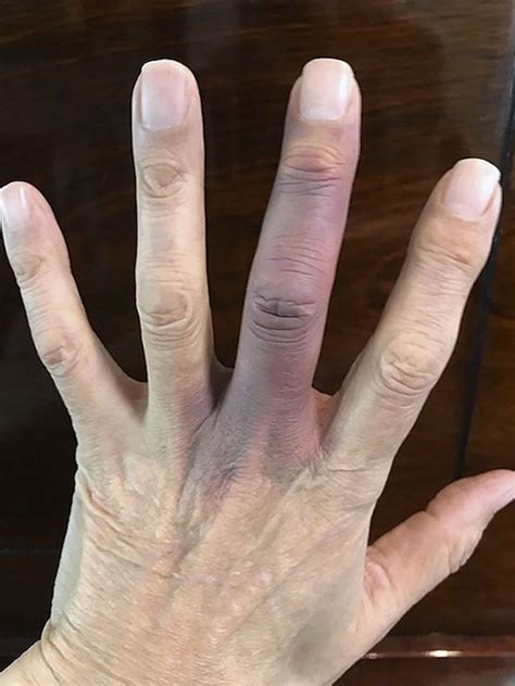 Thrombophlebitis In Fingers