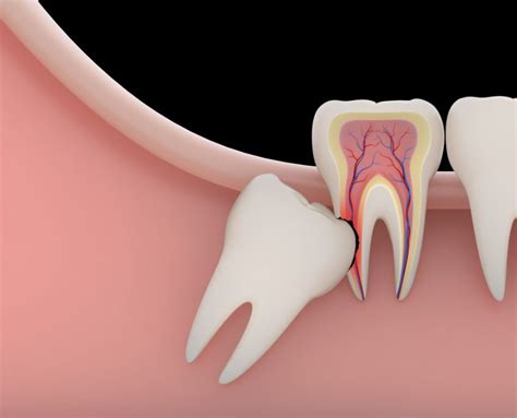 Symptoms Of Impacted Wisdom Tooth Shinagawa Orthodontics