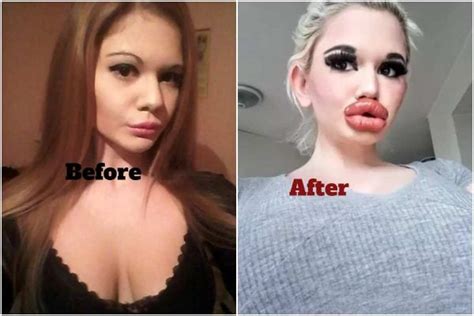Woman Who Wants To Be Real Life Barbie Shows Off Huge Lips — Guardian Life — The Guardian