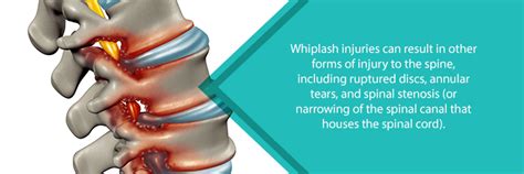 Whiplash Injuries Complications Nj Spine And Orthopedic