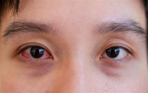 Sore Eyes Causes And Treatment What You Can Do