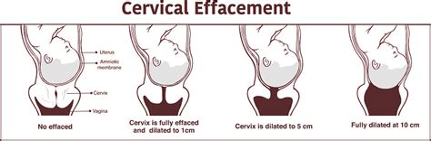 Vector Cervical Effacement And Dilatation During Labor Stock
