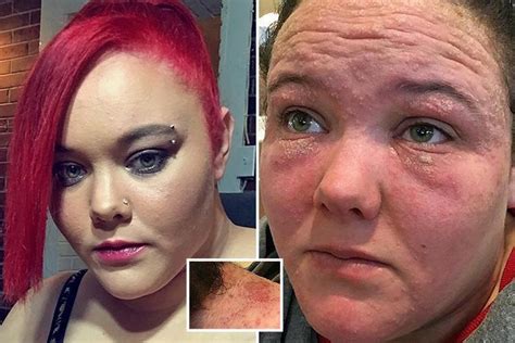 Mum Scarred By Horrific Allergic Reaction To Hair Dye Which Was Mistaken For Herpes The