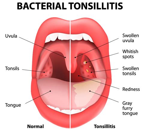 Tonsils And Adenoids Mr George Murty