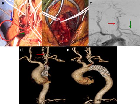 Aberrant Left Vertebral Artery Transposition And Concomitant Carotid