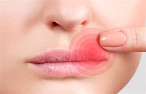 Typische symptome sind entzündete und schmerzhafte bläschen im bereich der lippen. Wann wird Lippenherpes gefährlich? | Lippenherpes Ratgeber