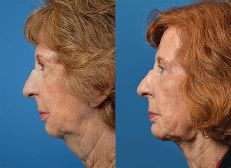 Patient 122406524 Laser Assisted Weekend Neck Lift Before And After