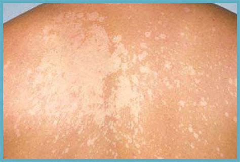 Fungal Skin Infections Causes And Cure All Things Gud