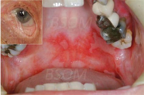 Sore Mouth Pemphigoid British And Irish Society For Oral Medicine