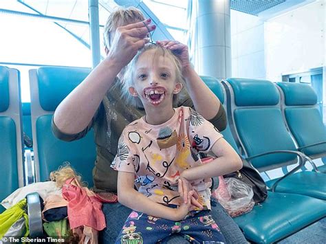 Russian Girl Who Was Born With No Lips Or Chin Flies To London For