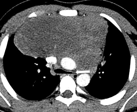 Large B Cell Mediastinal Lymphoma Axial Ct In A 15 Year Old Boy With
