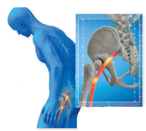 Knee Or Hip Pain From Your Back Arthritis Advisor