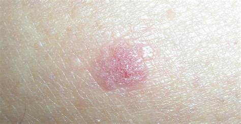 Squamous Cell Carcinoma Warning Signs And Images The