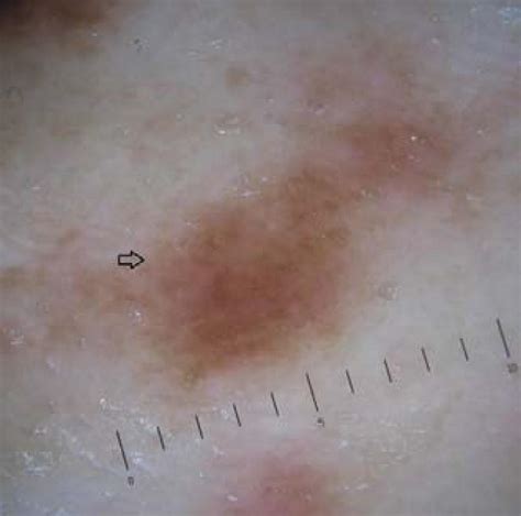 Scielo Brasil Dermatoscopic Findings Of Urticaria Pigmentosa