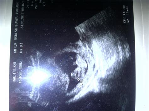 Janin anda 11 minggu sekitar 1,6 inci dan beratnya sekitar 0,25 ons. usg usia 10 minggu apa sudah terlihat baby nya ya bun ...