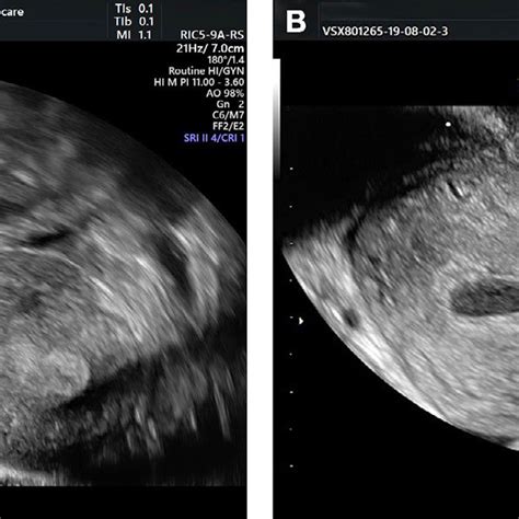 Control Ultrasonography Showing Normal Looking Cervix 7 Days After The Download Scientific