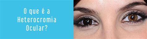 Que Heterocromia Ocular Oculari Hospital Oftalmol Gico