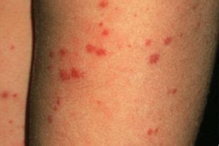 Derm Dx Small Red Spots On The Lower Extremities With Knee Pain Clinical Advisor