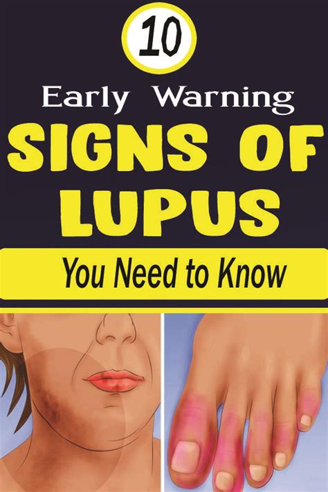 10 Early Warning Signs Of Lupus You Need To Know Warning Signs Body