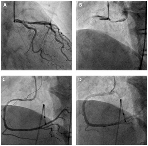 Successful Treatment Of A Case Of Acute Myocardial Infarction Due To