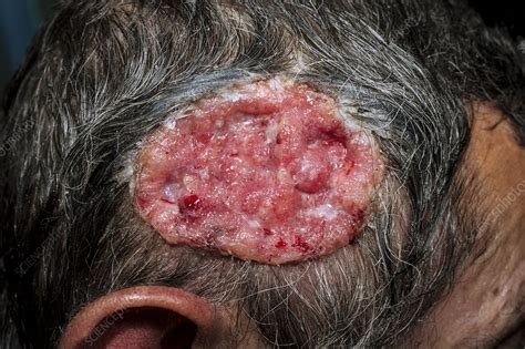 Squamous Cell Cancer On The Scalp Stock Image C014
