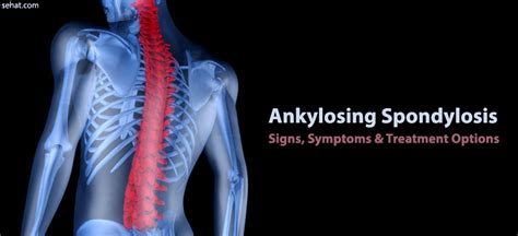 Ankylosing Spondylosis Symptoms And Treatment