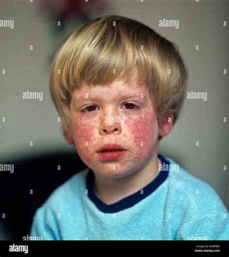 Measles Rash On Face Of Infant Patient Stock Photo Alamy