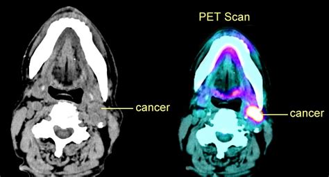 A pet scan is often used for parts of. Difference Between Ct Scan And Pet Scan - ct scan machine