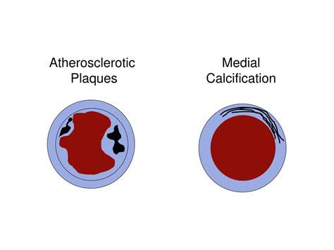 Ppt Vascular Calcification Powerpoint Presentation Free Download
