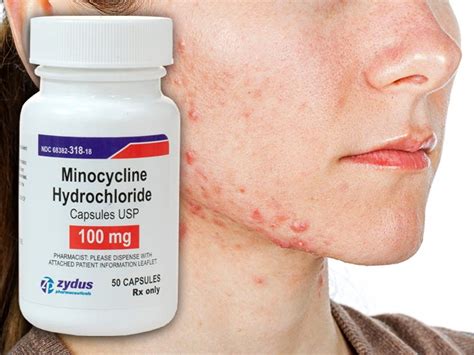 Minocycline For Acne Changes Skin Microbiota Medpage Today