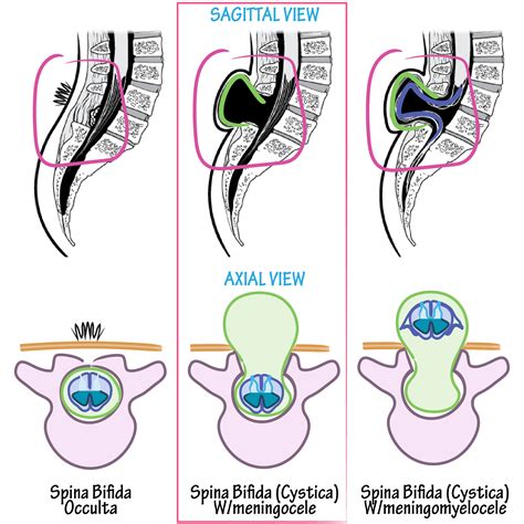 neuroanatomy glossary spina bifida with meningocele draw it to know it