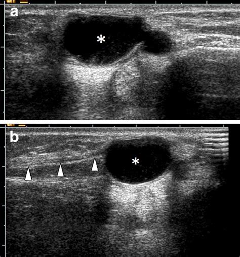 Synovial Cyst Ultrasound