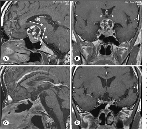 Figure 1 From Surgical Outcome Of Endoscopic Endonasal Surgery For Non