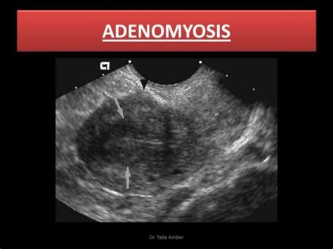 Medical Ultrasoundadenomyosis