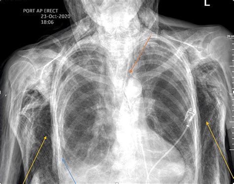 Surgical Emphysema Chest X Ray Sexiz Pix