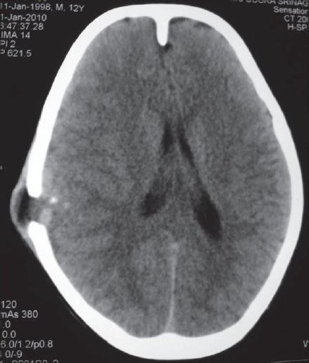 Plain Ct Scan Of Head Revealing Erosion In The Parietal Bone With