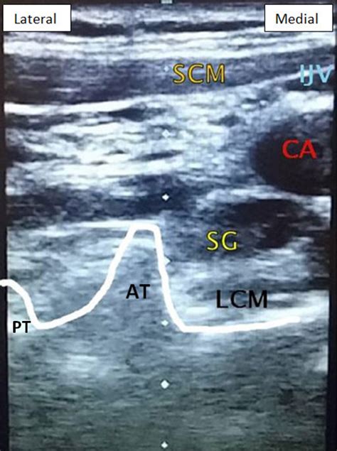 How I Do It Stellate Ganglion Blocks