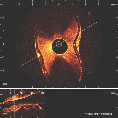 PDF Optical Coherence Tomography For Endodontic Imaging Art No 68430F