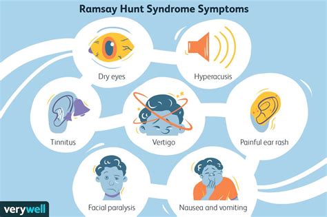 Ramsay Hunt Syndrome Herpes Zoster Oticus Symptoms And Treatment