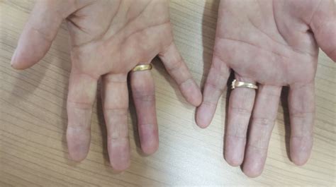 Paroxysmal Finger Hematoma Or Achenbach Syndrome Captions Trending Update